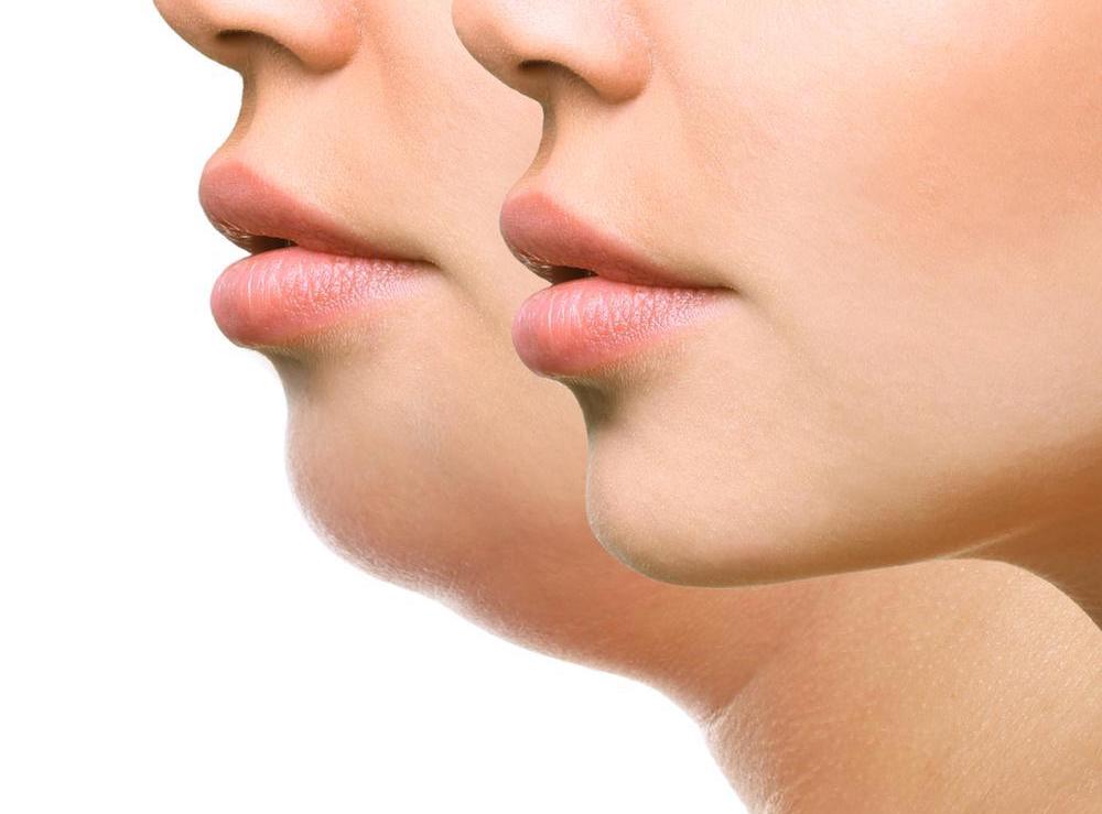 The “Zoom Effect”: Why Chin Contouring is the Procedure of the Decade