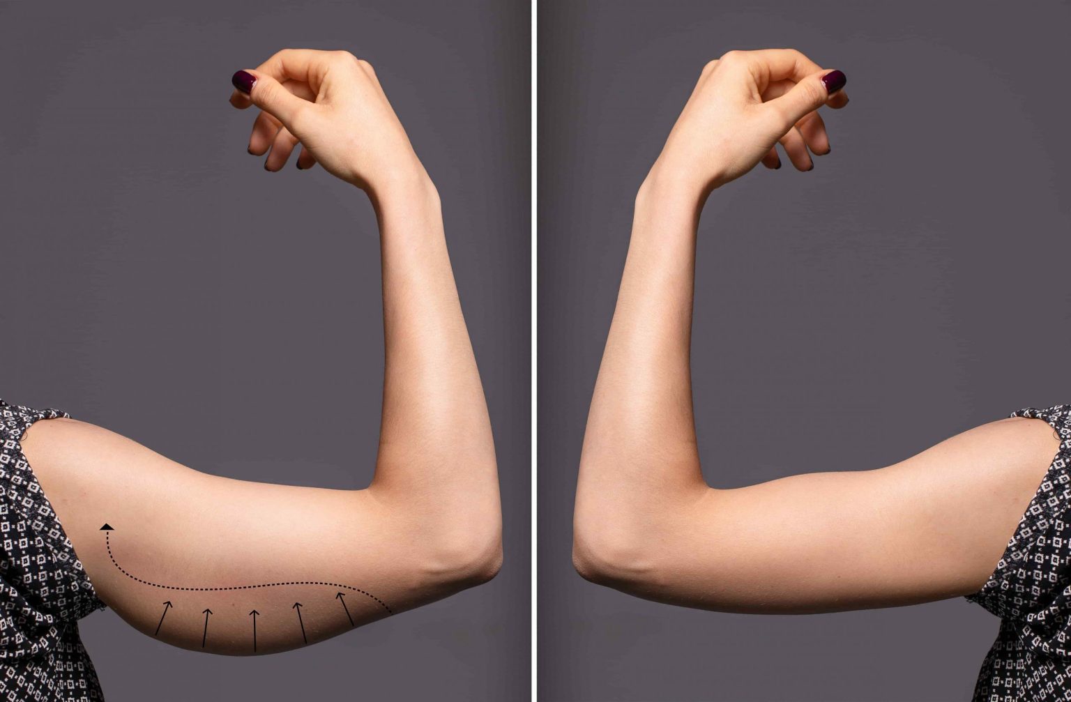 Waving Goodbye to Insecurity: The Truth About Arm Lifts