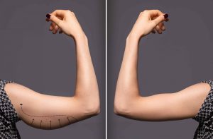 Waving Goodbye to Insecurity: The Truth About Arm Lifts