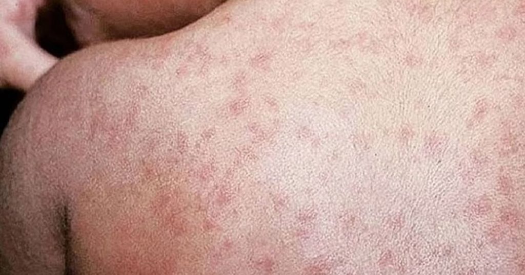 Cebu Health Officials Fight Measles Vaccine Fake News